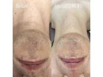 ハイリー(Hily)/メンズ脱毛 ひげ before、after