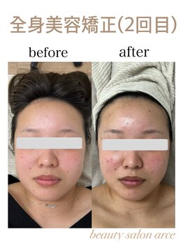 アルセ(arce)/美容整体×小顔矯正 小顔に