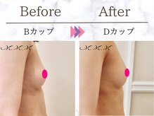 エムエムエム 表参道Luxeサロン(M.M.M)/【バストアップ例】　B→Dカップ
