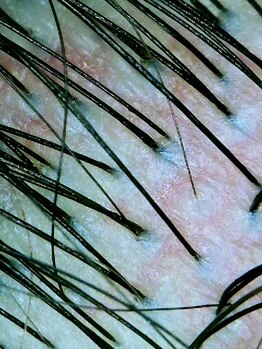 アンジール(ANJIR)/赤い頭皮（注意）