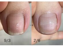 ロンディネ(Rondine)/巻き爪ケア&Nail trim