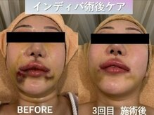 ラディアント(Radiant)/インディバ術後ケア/肌質改善