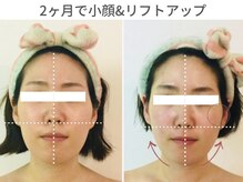 小顔コルギアンドフェイシャルサロン ジュエル(JEWEL)の雰囲気（エラ張り・頬の張りを改善して卵型の小顔に仕上げました）