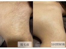 メンズアルファ/【肩】光脱毛before after 20代