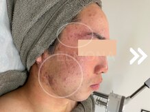 グリーンピール エルモナ(GREENPEEL ELMONA)/【グリーンピール５Days】