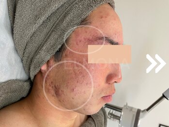 グリーンピール エルモナ(GREENPEEL ELMONA)/【グリーンピール5Days】