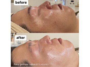 エイティ(Atey)/メンズ★肌質改善