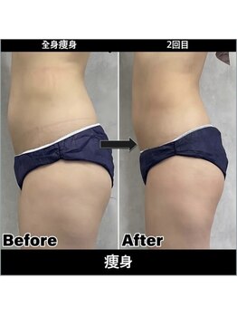 Sスタイルスタジオ 福岡天神/全身そう身2回目のお客様