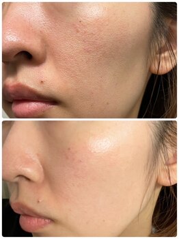 ジョルジオ東京/プラズマフラクショナル