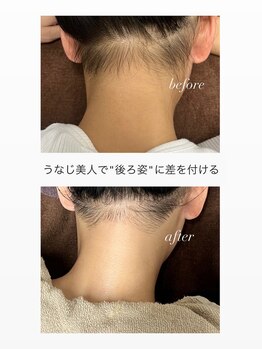 スマイルネイル(SMILE NAIL)/首元すっきりうなじ脱毛