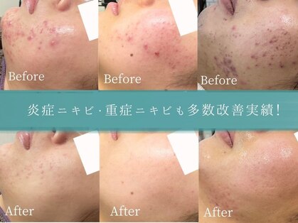 ニキビケア研究所 本厚木店の写真
