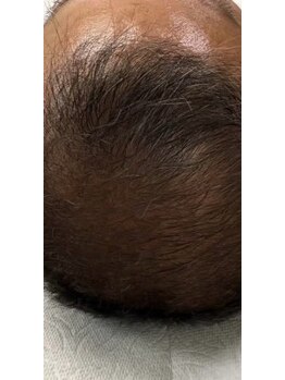 リレア ラカ(Relair Laka)/頭皮環境を整えるスカルプケア☆