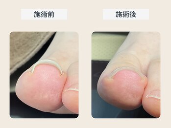 ルポ 伊勢/巻き爪ケア