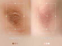 クローバー 松戸(clover)/【ルメラ】ひじ　黒ずみケア