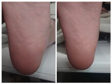 アンティ(Aunty)/踵のカサカサケア