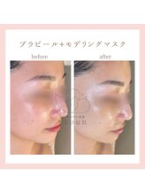 韓国肌管理yeoun【ヨウン】ROMAPINK/黒ずみ/毛穴/プラピール/ララピール福岡天神/プラピール/プラピール福岡