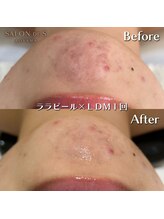 サロン ド エス アオヤマ(SALON DE S AOYAMA)/ララピール＆LDM（ニキビ）