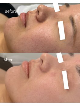 オン(on.)/《お客様症例》施術1回