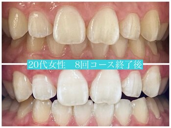 歯のホワイトニング 岐阜アクティブG店/Wホワイトニング施術写真☆