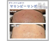 メイリリー(Meilily)の雰囲気（ニキビケア◎マリンピーリング１回の変化♪）