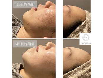 ラヴィオーラ 梅田店(La Viora)/ダイヤモンドハーブピーリング