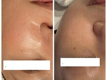 ジョーヌ(JAUNE)/毛穴スッキリ！