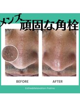 ピアリーノ(Pialino)/ハイドラ毛穴洗浄