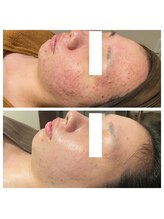 ビジュープラス 神栖店(Bijou+)/赤み・ニキビケア