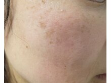 リノ(Lino)/しみケア