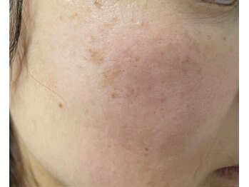 リノ(Lino)/しみケア