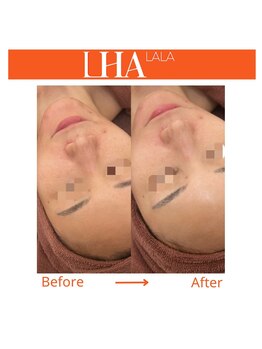 ラピスビューティーサロン(Lapis beauty salon)/韓国肌管理ララピール！