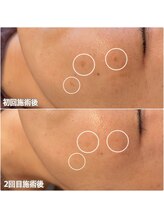 ジン フォー ユアビューティー(JIN for your beauty)/施術経過