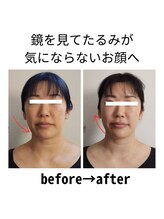 ニコ(Nico)/before・after　小顔矯正