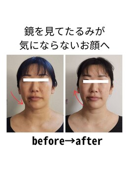 ニコ(Nico)/before・after　小顔矯正