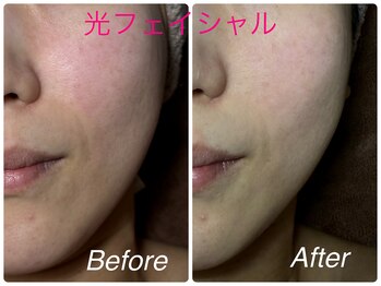 ココプラス(COCO+)/プラズマ光フェイシャル