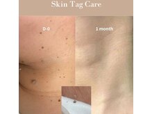 ～イボケア経過写真～