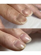 健康爪に戻す自爪育成