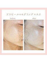 韓国肌管理yeoun【ヨウン】ROMAPINK/黒ずみ/毛穴/プラピール/ララピール福岡天神/プラピール/プラピール福岡
