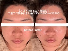 ソワン ド ブランシュ ライフ八戸ノ里店(Soin de Blanche)/二重アゴにレッドショット！