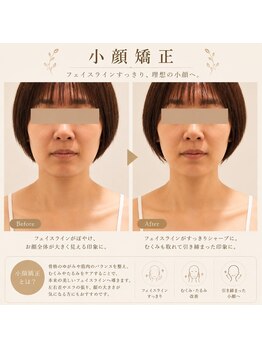 レイ(Lei)/リフトデザイン小顔