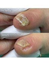 巻き爪補正店 札幌店/ 【副爪ケア】