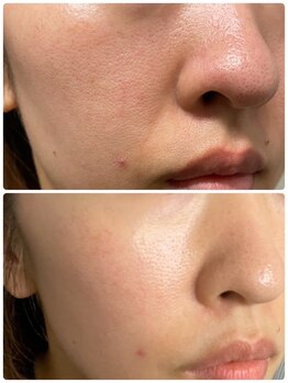 ジョルジオ東京/プラズマフラクショナル