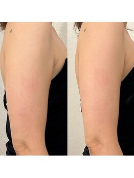 リム ビューティー(RYM BEAUTY)/最新超音波