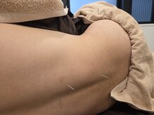 ムラサキ鍼灸治療院(MURASAKI鍼灸治療院)/急な腰痛には鍼灸施術