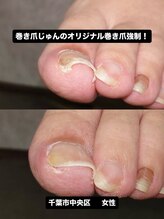 巻き爪じゅん 千葉駅前店/巻き爪と痛みを根本改善