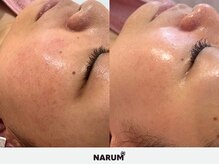 ナルムフェイシャル 代々木(NARUM facial)/水光ピーリング