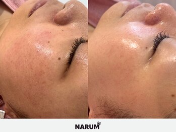 ナルムフェイシャル 代々木(NARUM facial)/水光ピーリング