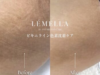 クローバー 松戸(clover)/鼠けい部（股関節付近）　