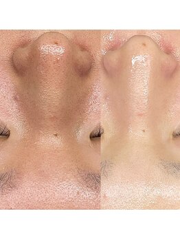 ブルーバケーション(Blue Vacation)/毛穴ケア