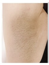 しん整骨院/わき脱毛